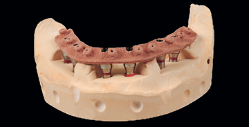 CAD/CAM Abutments and Bars